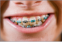 Health & Fitness in Schertz, TX: McGarrell Orthodontics